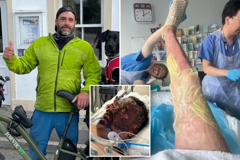 Dad survives five week coma after “fireball” explosion while making gin