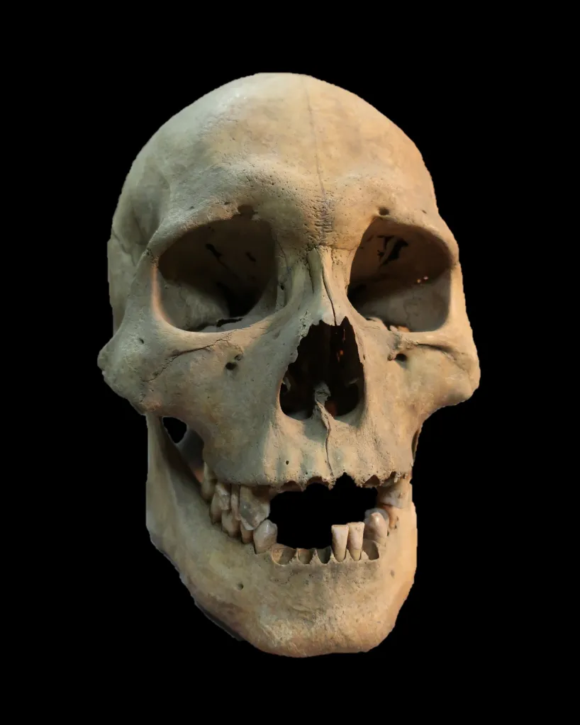 Skull of an adult woman who was infected with the plague, found in Siberia.