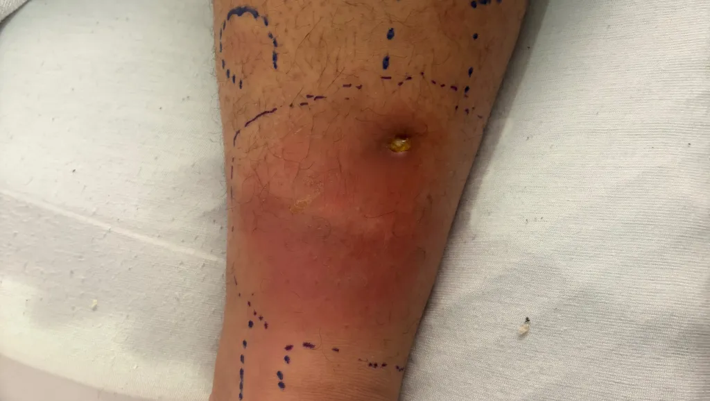A leg with a red, inflamed area and a pustule, marked with blue pen.
