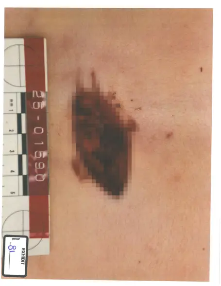 A reddish-brown wound on skin next to a ruler labeled "EXHIBIT".